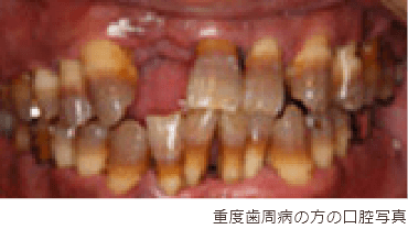 重度歯周病の方の口腔写真