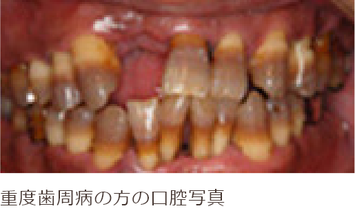 重度歯周病の方の口腔写真