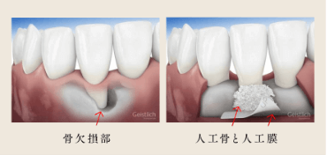 歯周組織再生療法:GTR(Guided Tissu Regeneration)法