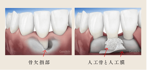 歯周組織再生療法:GTR(Guided Tissu Regeneration)法